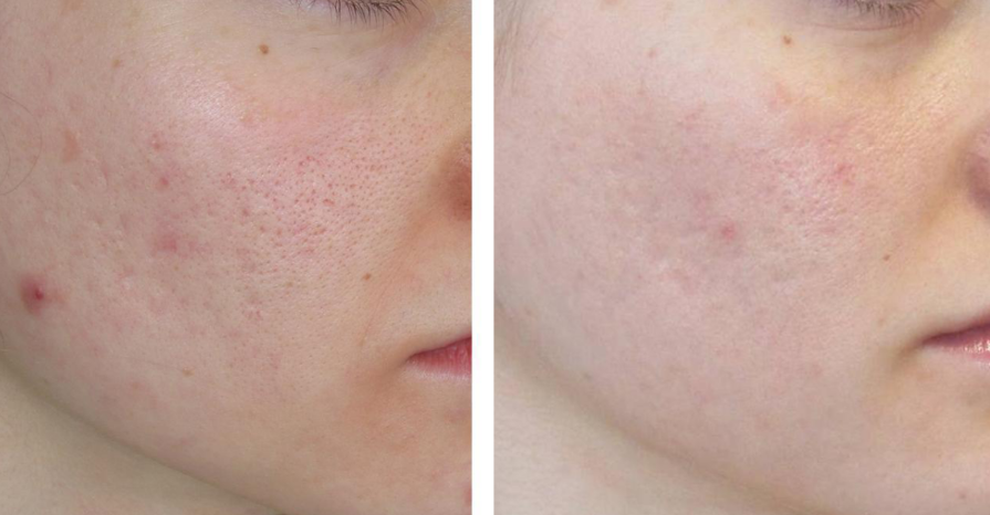 tratamientos faciales laser co2