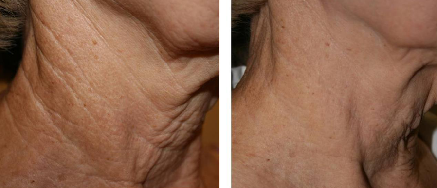 tratamientos faciales laser co2