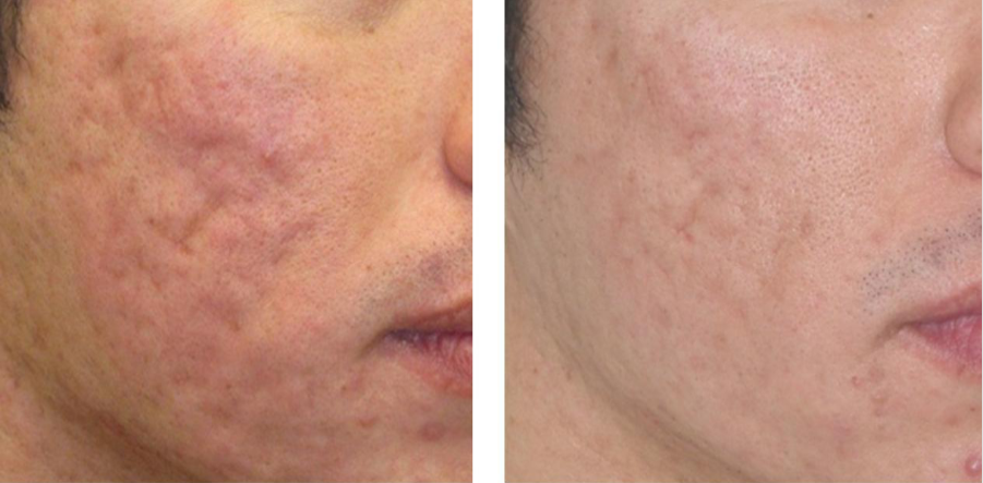 tratamientos faciales laser co2