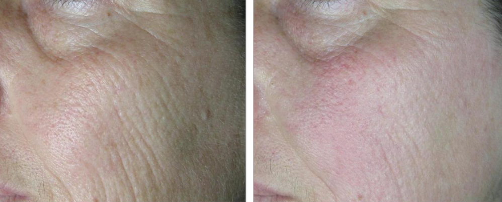 tratamientos faciales laser co2