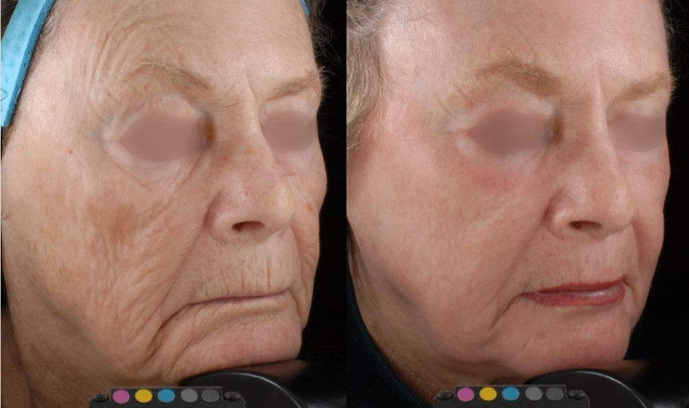 tratamientos faciales laser co2
