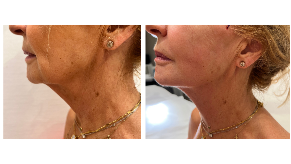 tratamientos faciales laser co2