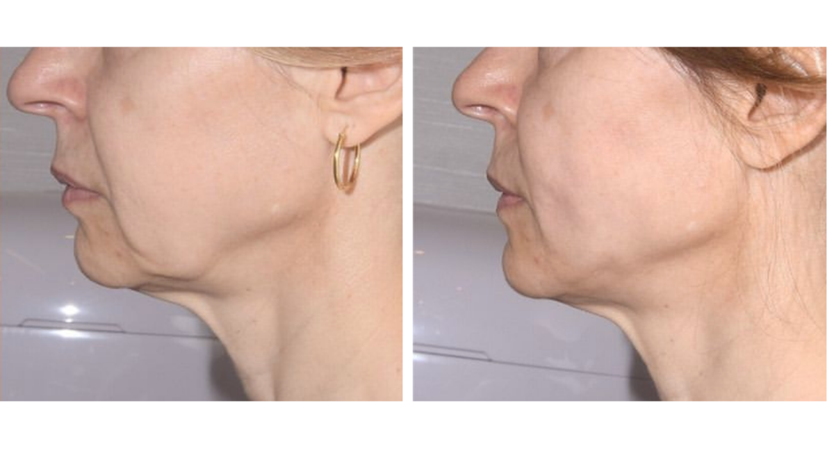 tratamientos faciales laser co2