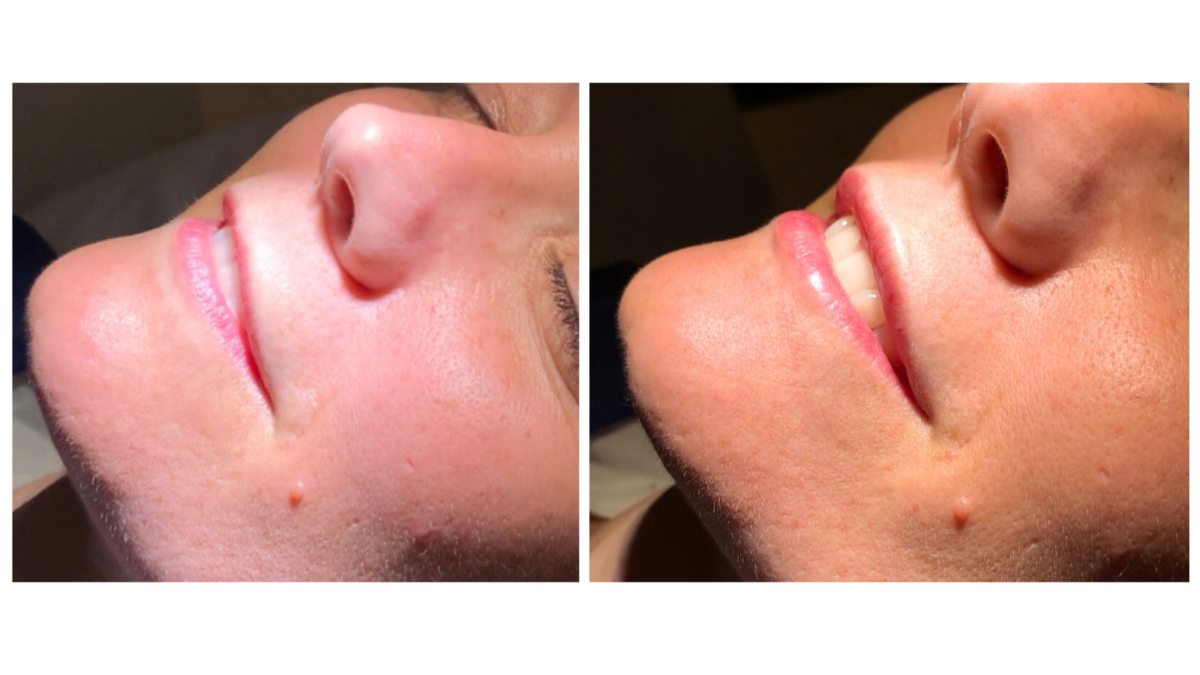 tratamientos faciales laser co2