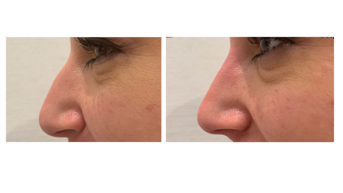 tratamientos faciales laser co2
