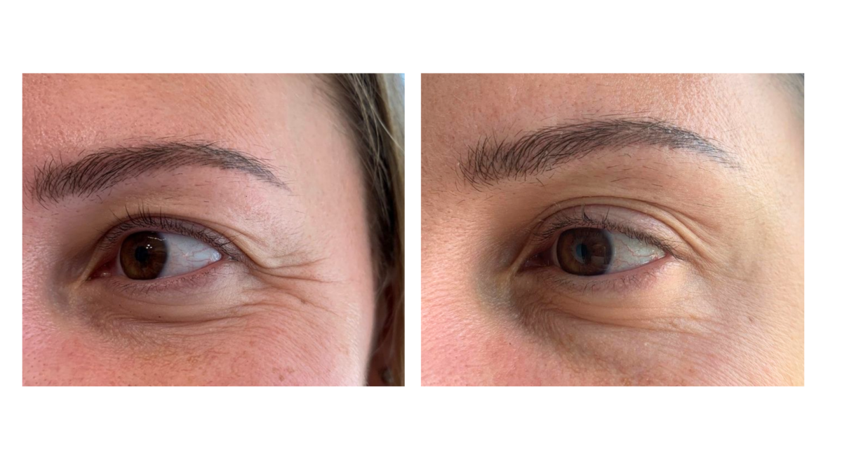 tratamientos faciales laser co2