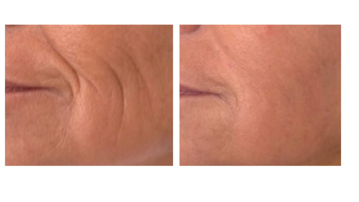 tratamientos faciales laser co2